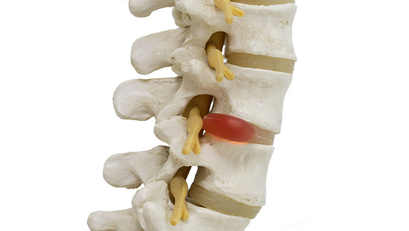 Herniated disc Ponderay Chiropractor at By Design Chiropractic