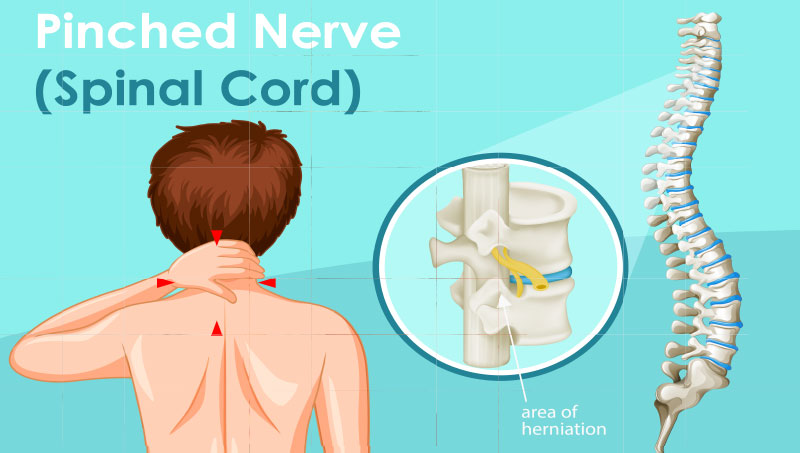 Pinched nerve Ponderay Chiropractor at By Design Chiropractic