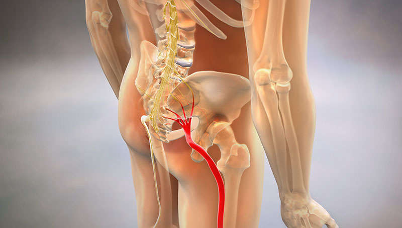 Sciatica expained by a Ponderay Chiropractor at By Design Chiropractic