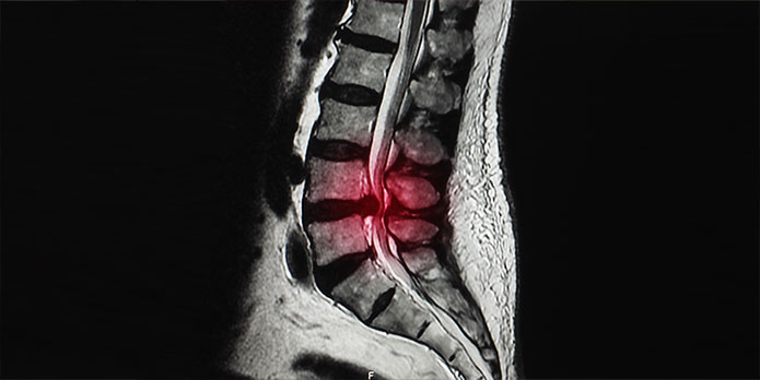 Chiropractic Care for Disc injuries